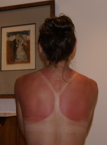 Jaime's burnt back